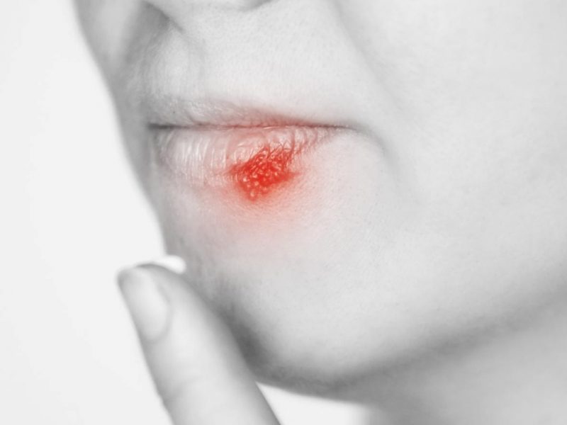 Girl With Herpes Sick Mouth Symptom Lips Cold Red Round Concept Finger Near Head Woman Face Healthcare Infection Close View